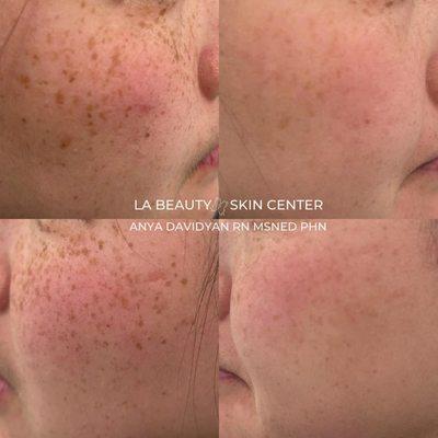 The difference 2 IPL treatments could make