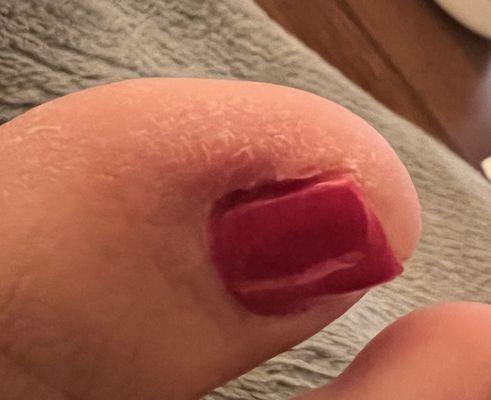 Infected toenail