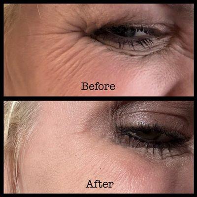 Botox around eyes