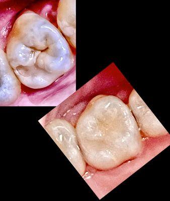 Cavities form where it's tight. Such as the grooves. It doesn't need to hurt. If it  does, it has advanced deeper near or into the nerve.