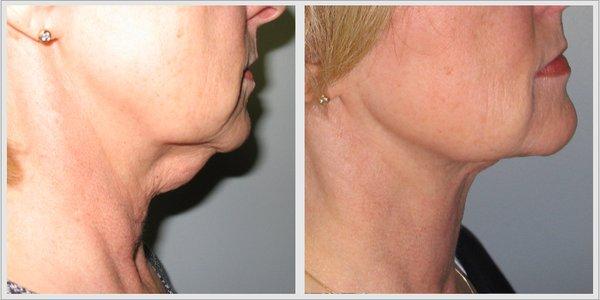 Neck liposuction