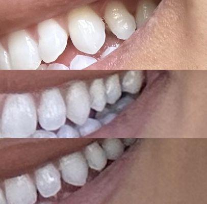 Top photo shows how disproportioned my tooth was after the filling. Middle and bottom pictures are my teeth before she butchered them