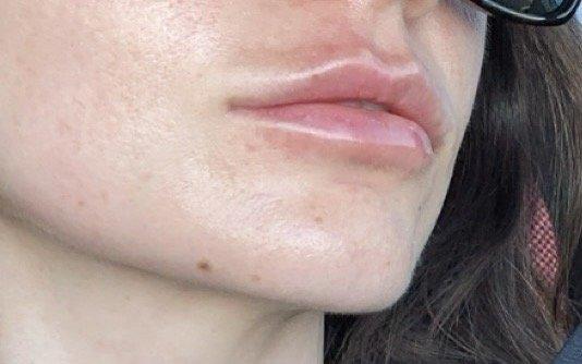 Right after Juvederm