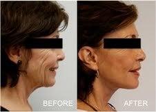 Before and After facelift patient.  Note the dramatic improvement to the patient's loose skin and neckline.