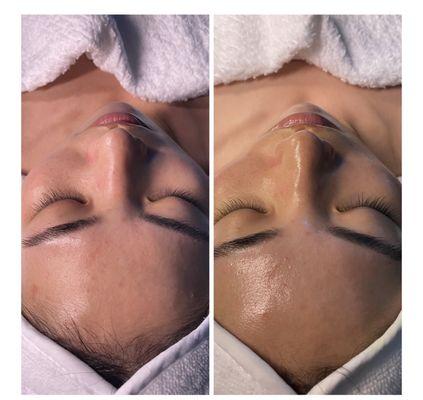 Deluxe Hydrafacial