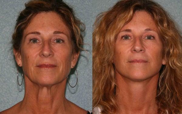 Neck lift and Mini-Facelift Before and After