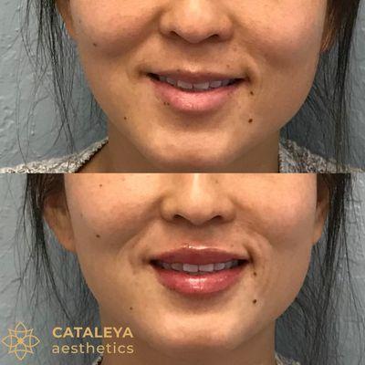 This lovely patient was super excited about her beautiful fuller lips! Photos are used with permission, always. #lipfiller #filler #volbella