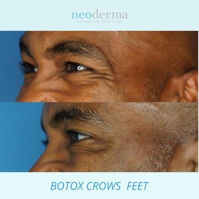 Before and after Botox treatment to reduce crows feet.