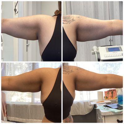 $199 Cryoslimming Fat Reduction Before and after - 1 st session