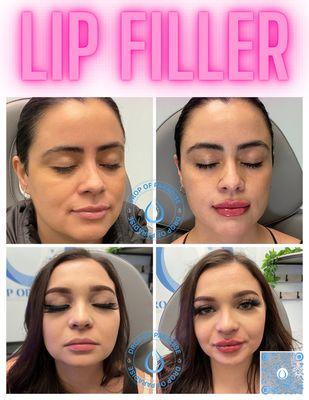 Lip filler! Get that plump volume that'll make heads turn!