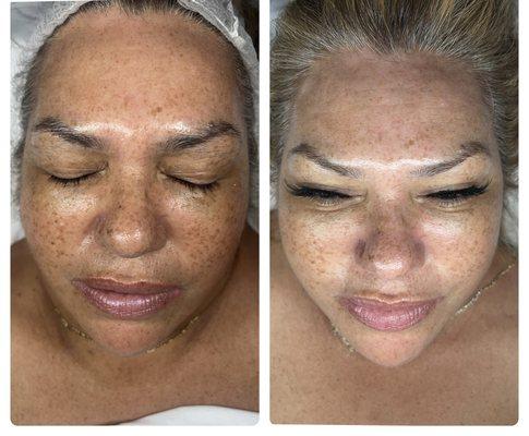 Non-surgical facelift facial before and after