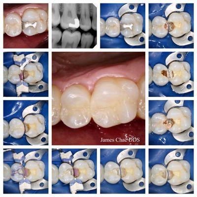 Never assume that the tooth needs a root canal treatment just because the cavity looks very deep on a bitewing x-ray.