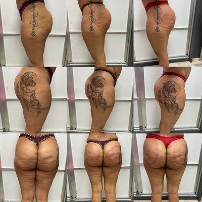 BUTT LIFT & CELLULITE REMOVAL