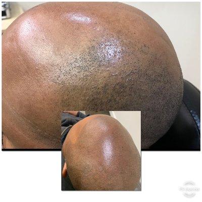 Get your hairline back from alopecia with scalp micropigmentation .