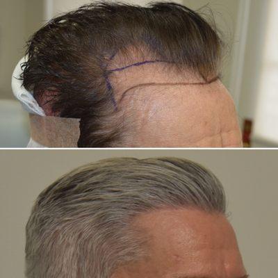 Only 6 months post FUE Hair Restoration at 50% growth. Double density still to come following next 10 months.