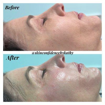 Oxygenated, Exfoliated, Rejuvenated skin! 
 Let me Help bring your "Skin Confidence" back ! 
 
 Image: before and after customized treatment