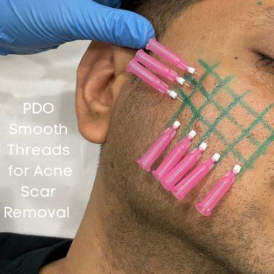 Acne Scar removal