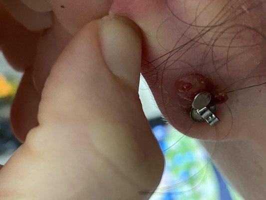 Piercing bump on ear piercing