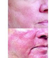 Chronic rosacea is successfully treated with a combination of therapies, including IPL.