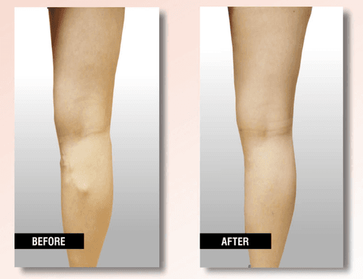 Get varicose veins free at USA Vein Clinics