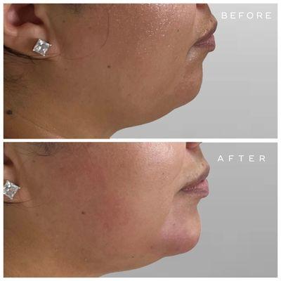 Before and after chin augmentation