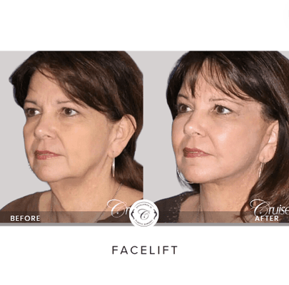 Facelift, Necklift/ neck tightening procedure.