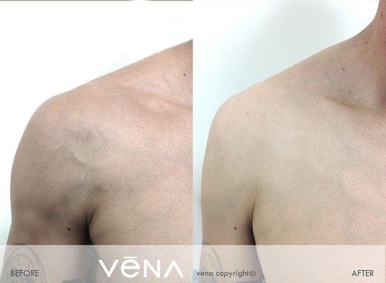 Chest Veins treatment at VeNA