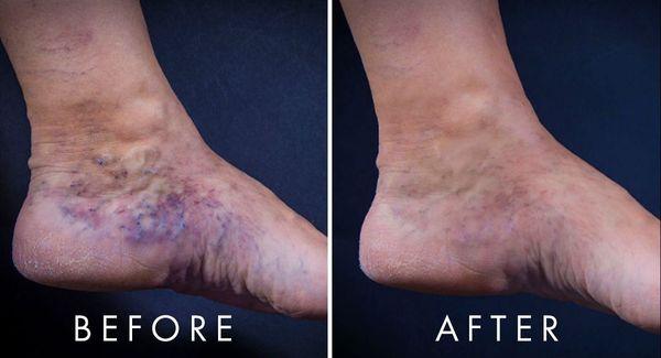 See an amazing vein treatment / removal transformation! Find customized solutions at San Diego Varicose Vein Treatment Center.