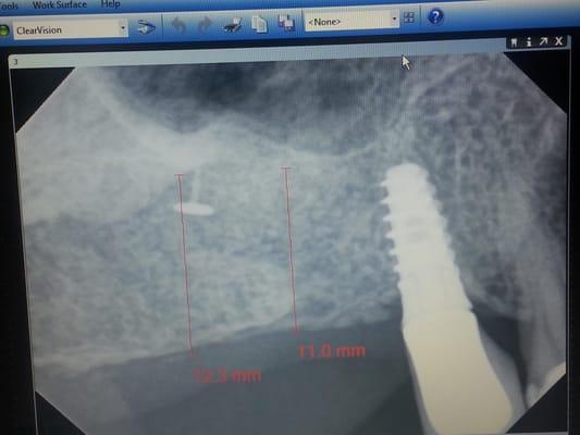 After Sinus Lift with PRF