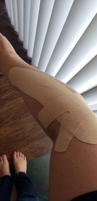 My lateral epicondylitis (tennis elbow) taped up with KT (Kinesio Tape) which helps alot.