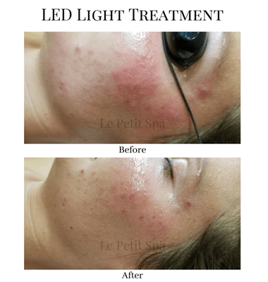 LED Light Treatment Therapy