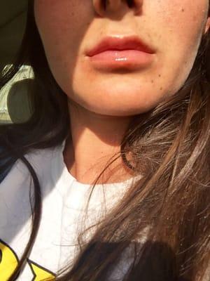 I had the nurse do my lips with juvederm and couldn't be happier with my results.