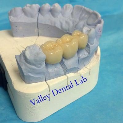 3 unit posterior 
bridge