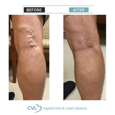 Varicose Veins
Before and After Treatment