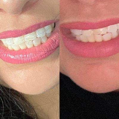 Before and after basic teeth whitening