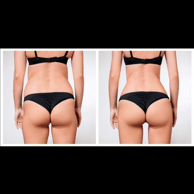 Liposuction and butt lift (BBL)