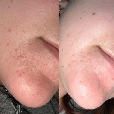 Acne before and after