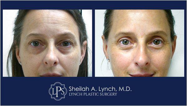 Eye lid Surgery Before and After Patient (upper & Lower) Get an expert opinion   Board Certified Plastic Surgeon  Dr. Sheilah A. Lynch.