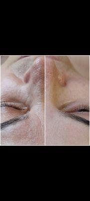 Filler Facial