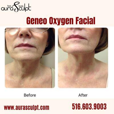 Are you looking for revitalizing in a natural way to give your skin a refreshed look ? It's the Glo2 Geneo Oxygen Facial!