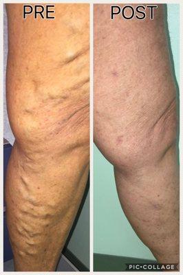 Do you suffer from varicose veins, if so call us today 410-761-8007 for your consultation