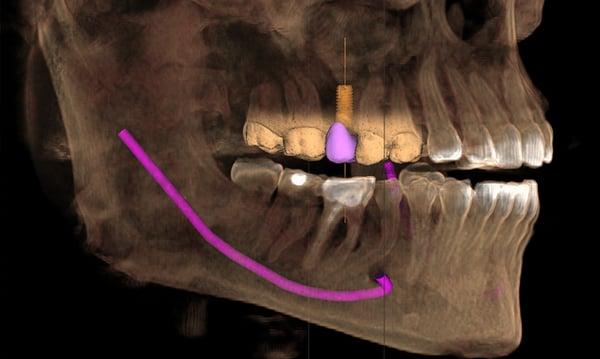 Implant Surgical Planning