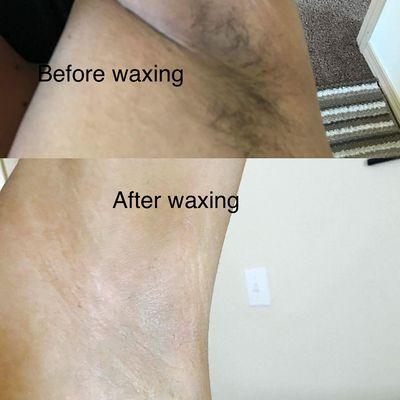 Underarm wax before n after