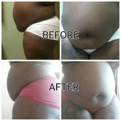 Upper, lower, and flanks lipo by Dr. Singer of American Lipo.