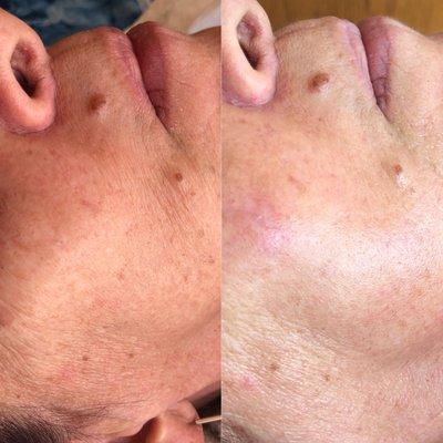 Before/After, Anti Aging Facial with High Frequency add on.