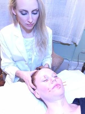 Facial Cosmetic Acupuncture