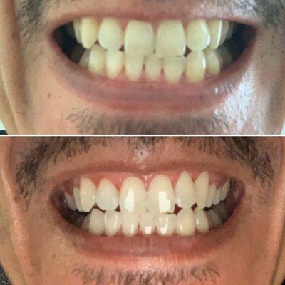 Before and after my zoom whitening