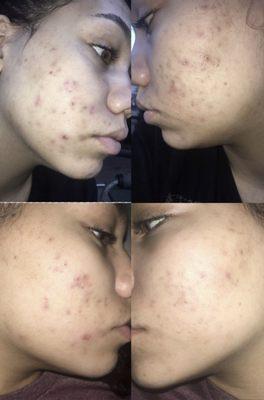 My hyperpigmentation and scars clearing up