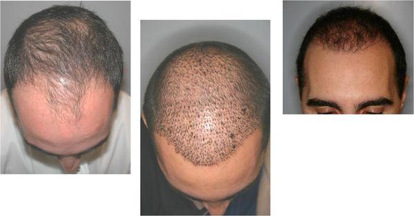 We did a 2500 graft case and the post result looks amazing.  Follicles are still growing in since this is only 10 months.