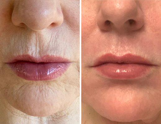 Before & After 1x HALO Laser treatment to address fine lines & wrinkles around the mouth.